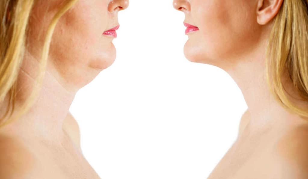 Double Chin treatment Billingshurst before and after results