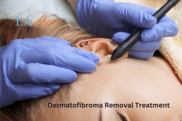 Dermatofibroma Removal Treatment Billingshurst
