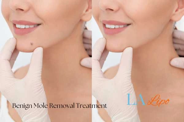 Before-and-after results following benign mole-removal treatment Billingshurst