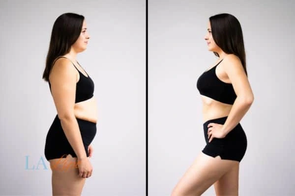 image of woman before and after results of LA-EMS Body Sculpting Billingshurst to help treat Diastasis recti