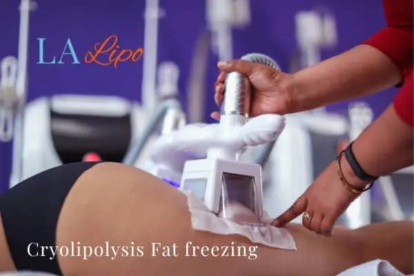 women getting fat freezing Billingshurst