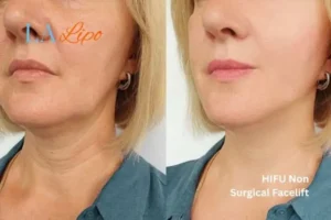 hi-fu for wrinkles Billingshurst before and after results