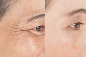 Before and after results of woman - HI-fu wrinkles reduction treatment Billingshurst