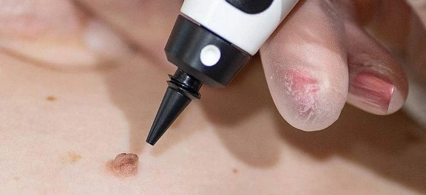 skin tag removal using cryopen Billingshurst