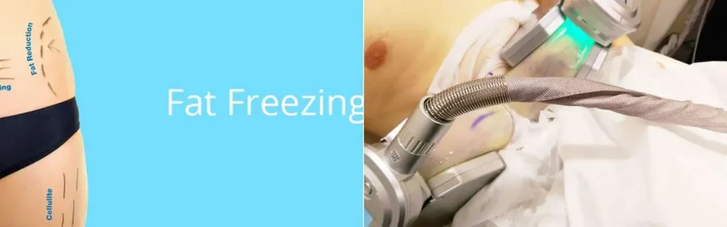 Fat freezing Billingshurst on multiple areas of the body