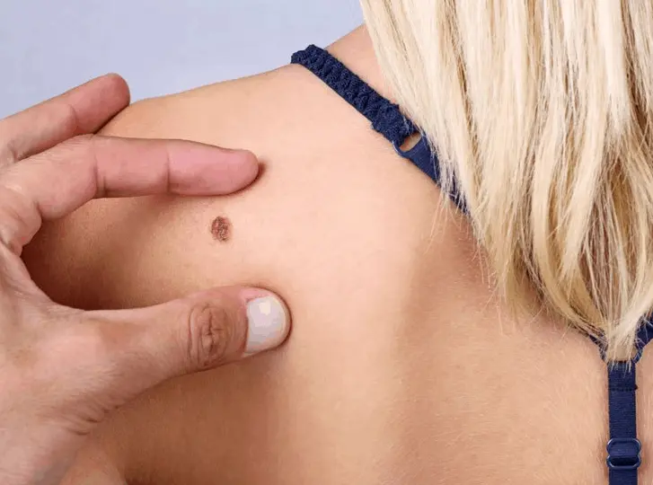 woman having mole removal Billingshurst consultation before treatment.