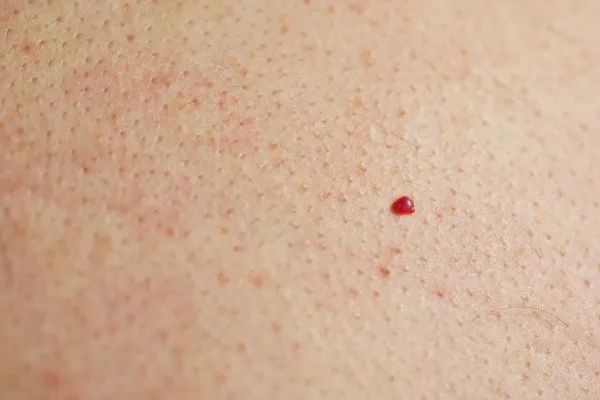 close up of a cherry angioma Billingshurst