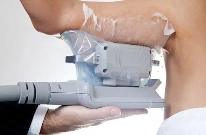 Picture of fat freezing Billingshurst on the upper arms.