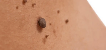 image of a skin tag Billingshurst