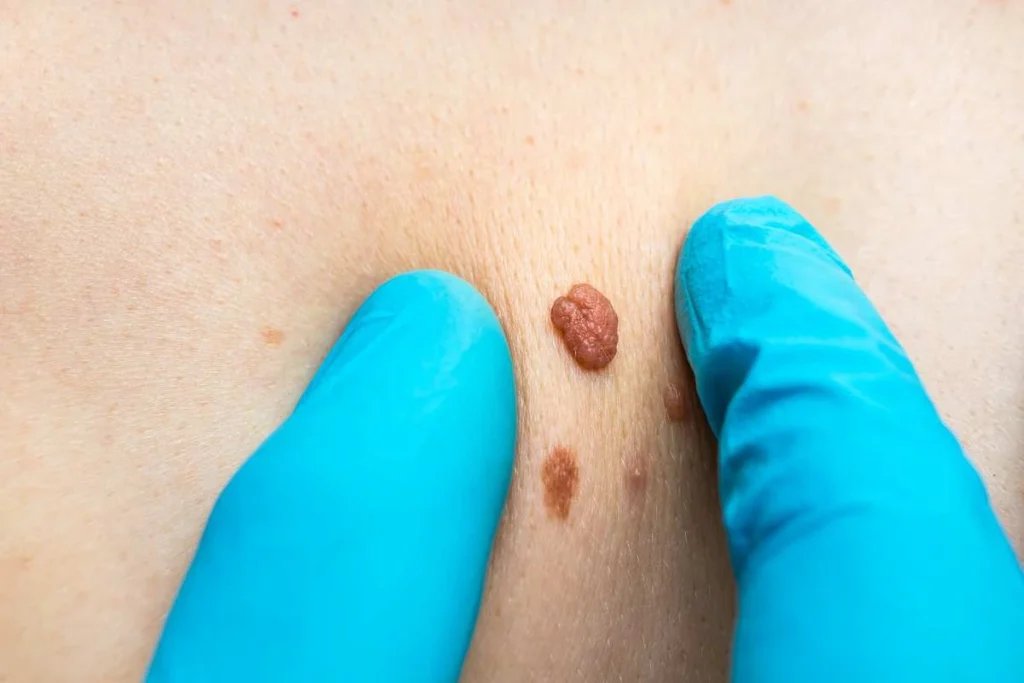 Consultant examining a skin tag Billingshurst