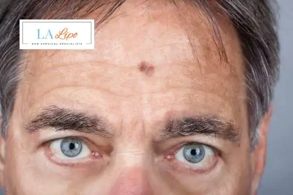 Solar Lentigo Removal Billingshurst image of man with mark on his forehead