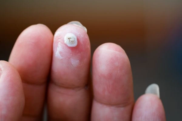 wart on person finger - cryotherapy to treat from LA LIPO Billingshurst