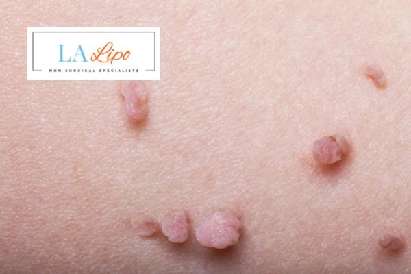 Does cryopen skin tag removal Billingshurst hurt? Find out now call our team today!