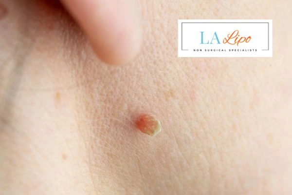 Book skin tag removal Billingshurst today speak to our team now!