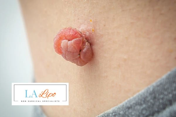 Interested in skin tag removal Billingshurst? Concerned about the pain? Find out more today!