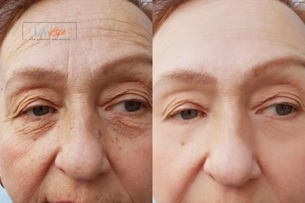 The powerful benefits of Morpheus8 Treatment Billingshurst - Call Our team today!