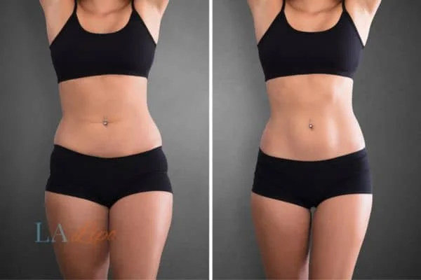 before and after results of non-surgical treatment to help a woman's body image and mental health Billingshurst