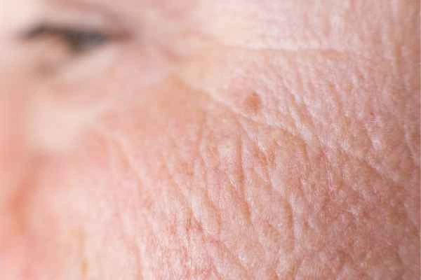 close up picture of a woman's face showing an age spot Billingshurst