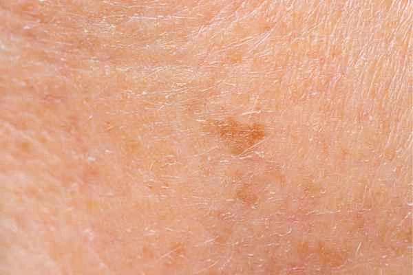 close up picture of age spots Billingshurst