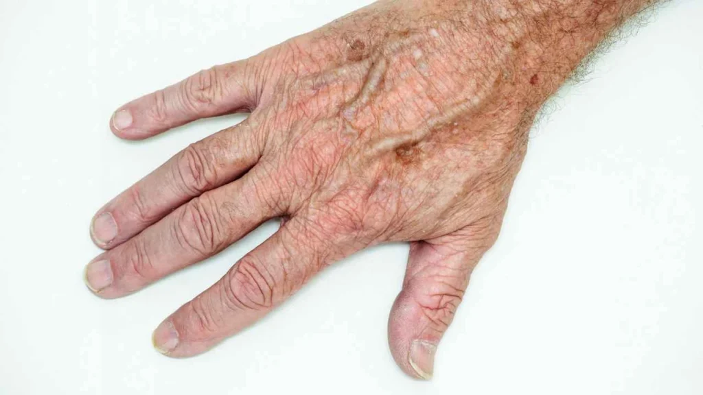 Male hand showing age spot Billingshurst