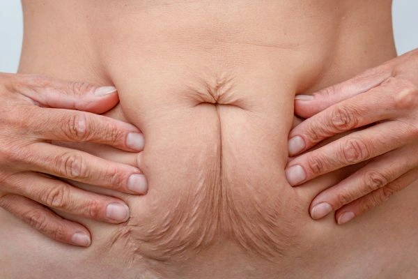 Image of a woman's stomach with loose skin - example of skin tightening Billingshurst options