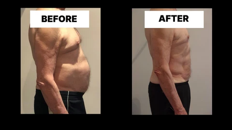 What Symptoms Can Diastasis Recti Cause in Men? Weak Core, Back Pain and Poor Posture Billingshurst